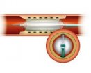 Orbus Neich Scoreflex Scoring Balloon | Used in Angioplasty, CTO Recanalisation | Which Medical Device